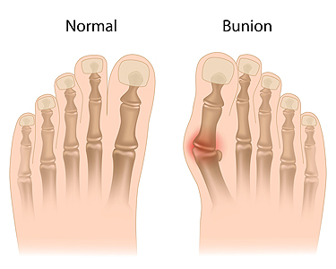 Can you have a bunion deformity and still have a straight toe