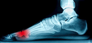 X-Ray depicting Sesamoiditis on patients foot