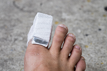 Patient with a Sprained Toe